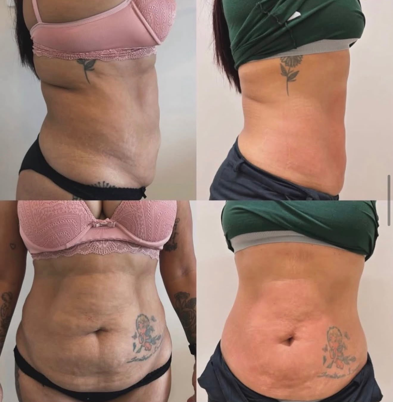 Real client before and after body sculpting transformations at Bootyful Sheffield
